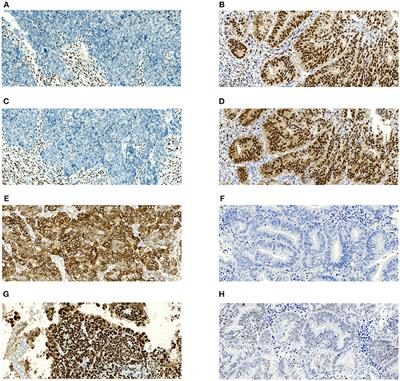 A Novel Approach to Preoperative Risk Stratification in Endometrial Cancer: The Added Value of Immunohistochemical Markers